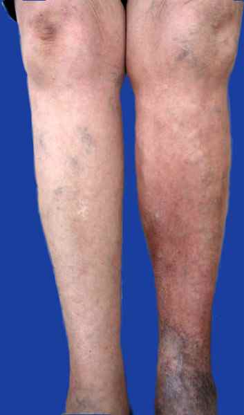 2.-varices-dermatitis-por-e