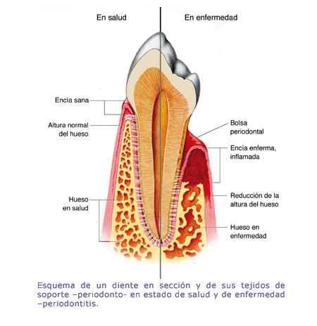 esquema-periodontitis-2