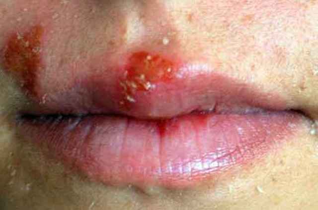 herpes_labial_photo-46319