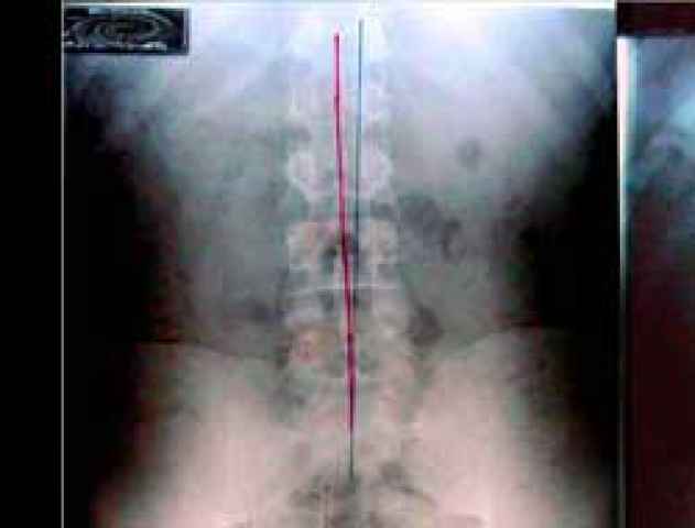 spinal1